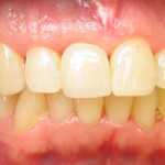 Implant Front Tooth After
