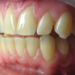 Chipped Tooth Repair Before
