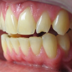Chipped Tooth Repair After