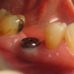 Implant (Molar) Before