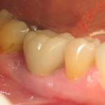 Implant (Molar) After