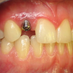 Implant Before